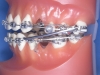 1 - Ancoragem para Retração Superior e Inferior - Mola Niti e Bull Loop