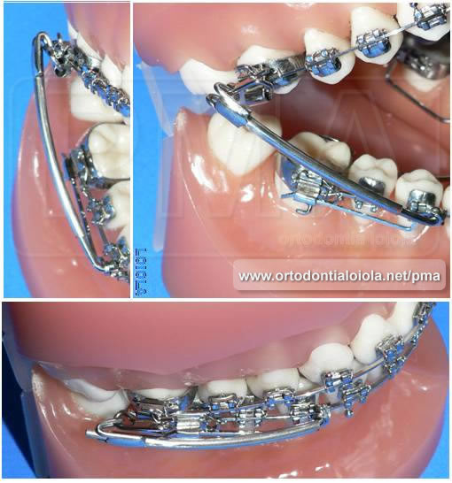 Protrator Mandibular  Arqueado Instalado