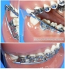 Protrator Mandibular  Arqueado Instalado