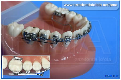 Trava Mandibular