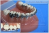 Trava Mandibular