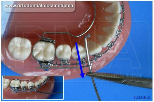 Haste Mandibular