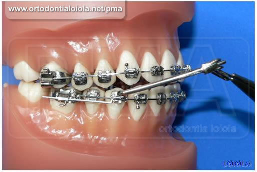 Instalação do Protrator Mandibular Arqueado