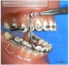 Instalação do Protrator Mandibular Arqueado