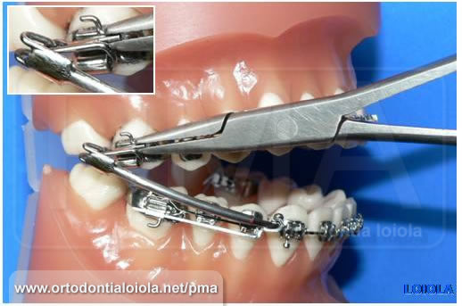 Instalação do Protrator Mandibular Arqueado