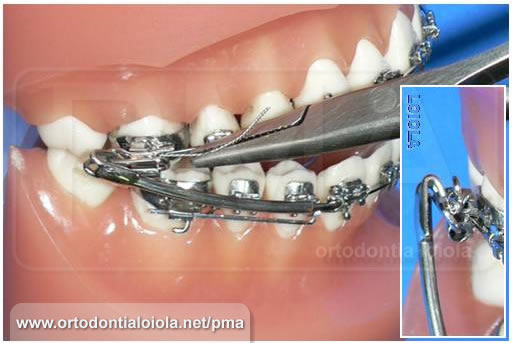 Instalação do Protrator Mandibular Arqueado